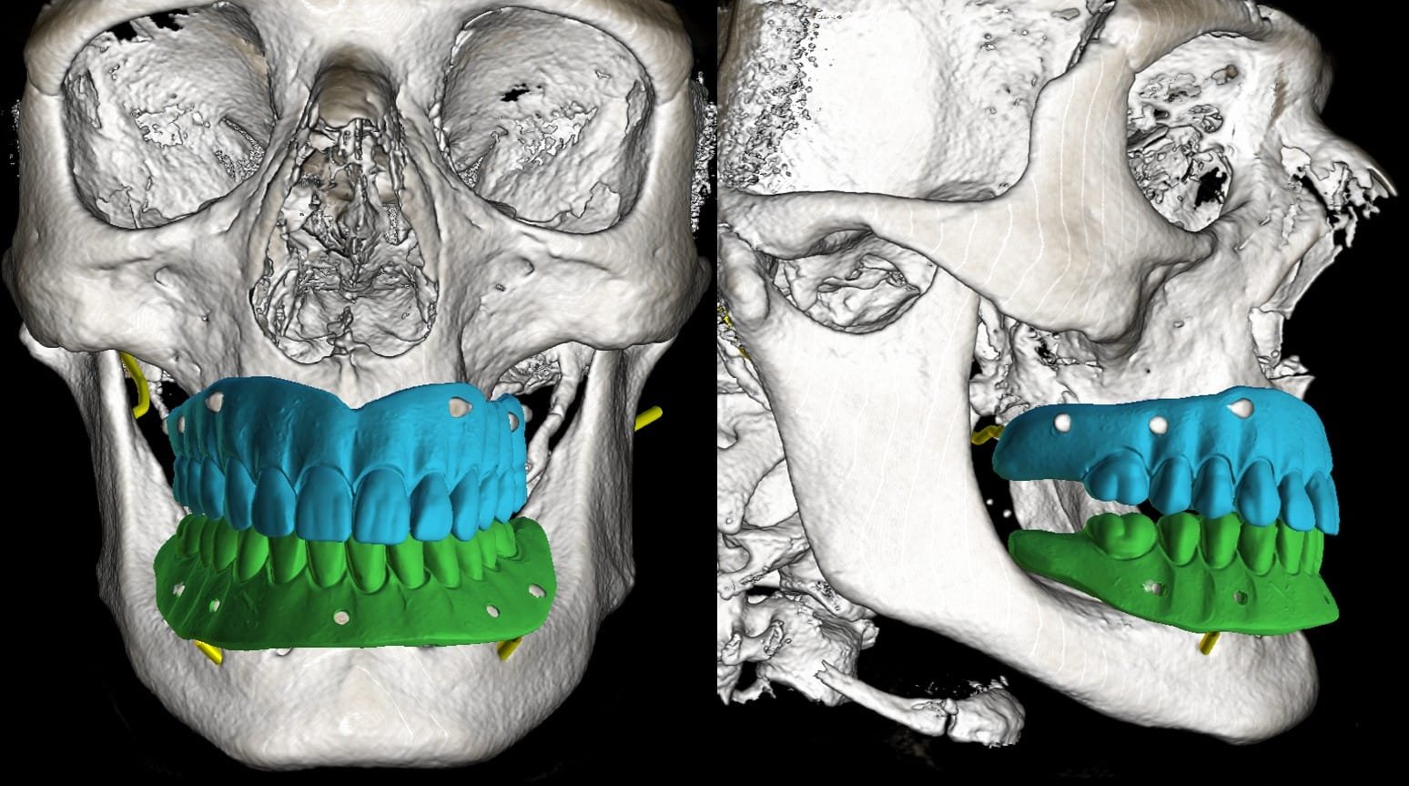 Software de planificación 3D para implantes dentales en Clínica Odontia